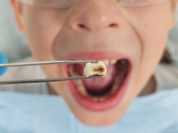 Best Emergency Treatment for Toothache in Selma, AL